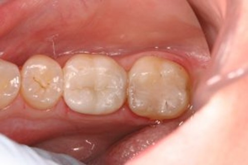 chipped molar